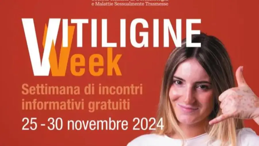 La 'Vitiligine Week' arriva in Calabria: incontri gratuiti con i dermatologi images La 'Vitiligine Week' arriva in Calabria: incontri gratuiti con i dermatologi