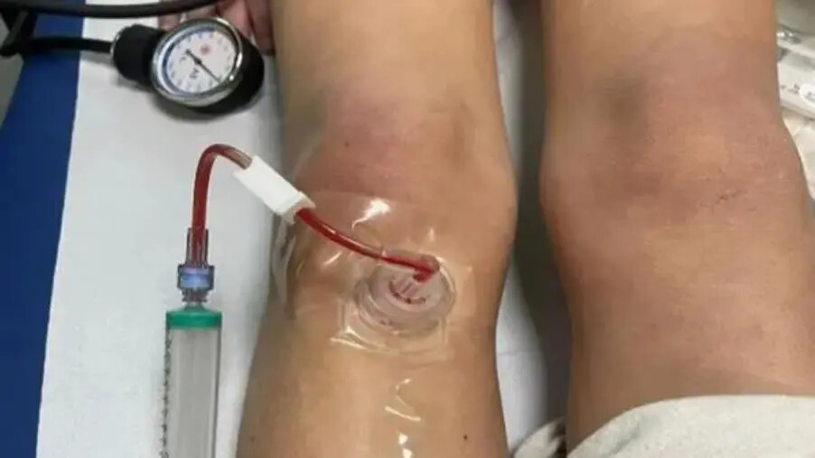 images Successo di un'equipe pediatrica nello spoke di Crotone: una squadra che corre contro il tempo