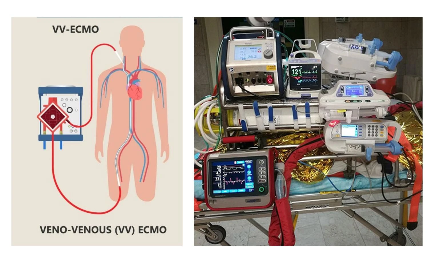 ECMO, Catanzaro hub salvavita: approvato il nuovo PDTA