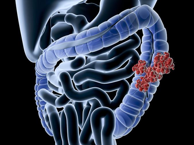 Aigo Calabria: "Non esiste programma regionale per la prevenzione del carcinoma colorettale. Urgente un confronto con le istituzioni" images Aigo Calabria: "Non esiste programma regionale per la prevenzione del carcinoma colorettale. Urgente un confronto con le istituzioni"
